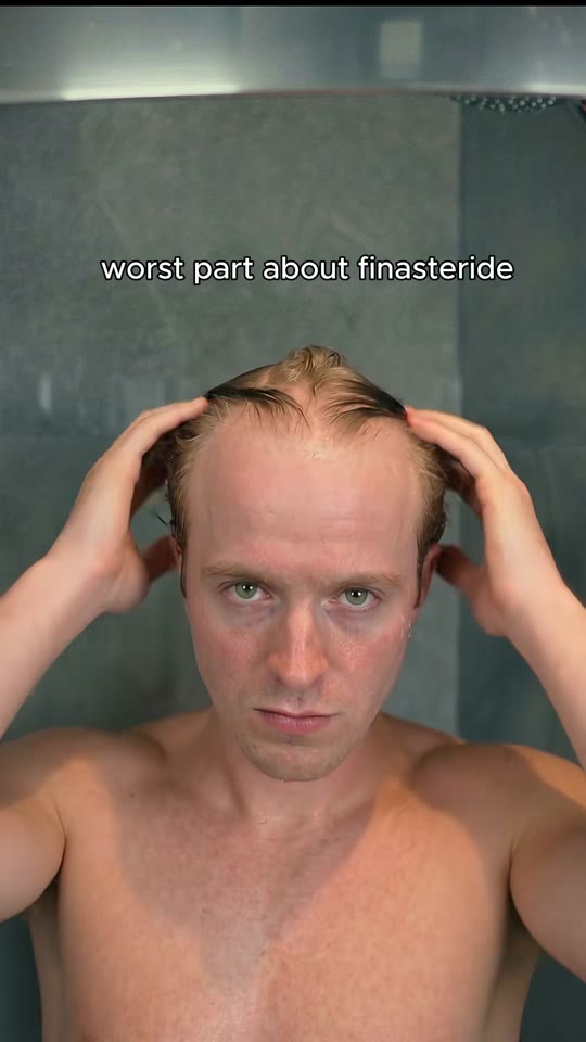@patrickhairtips's AI hair transplant claims, fact-checked