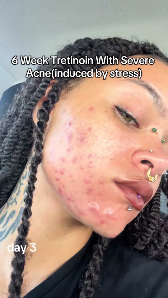 @knotchdbynae's tretinoin journey claims, fact-checked