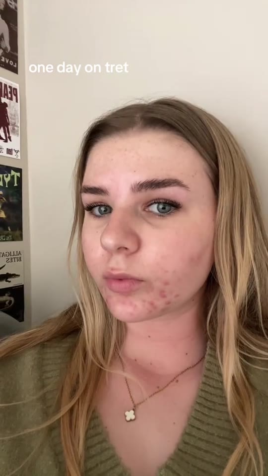 Tretinoin for acne: separating real results from TikTok timelines