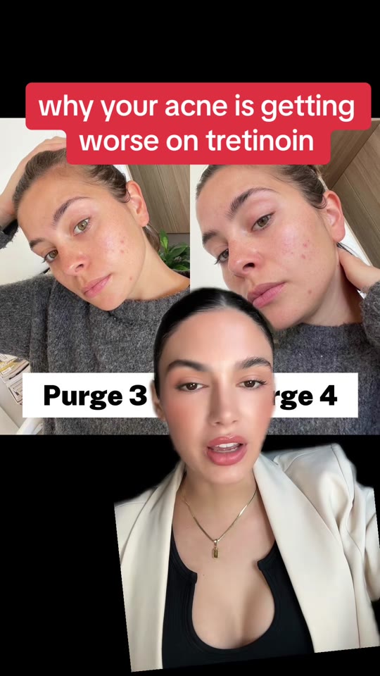 Np.Miranda's tretinoin advice gets checked by science
