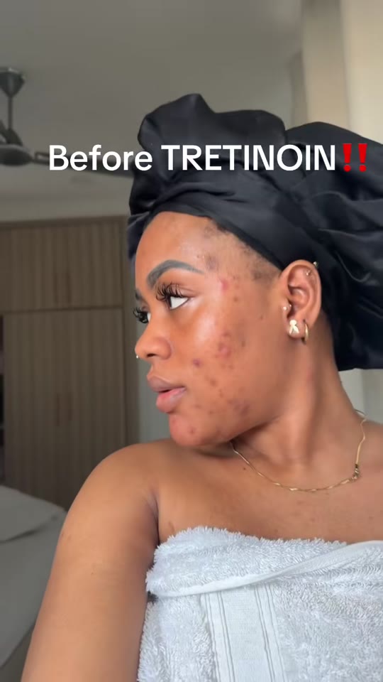This TikTok creator's tretinoin timeline isn't typical