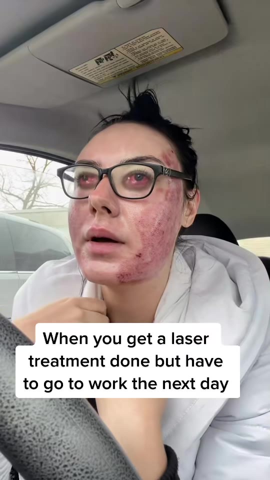 @jenniferglazer's ProFractional laser claims, fact-checked