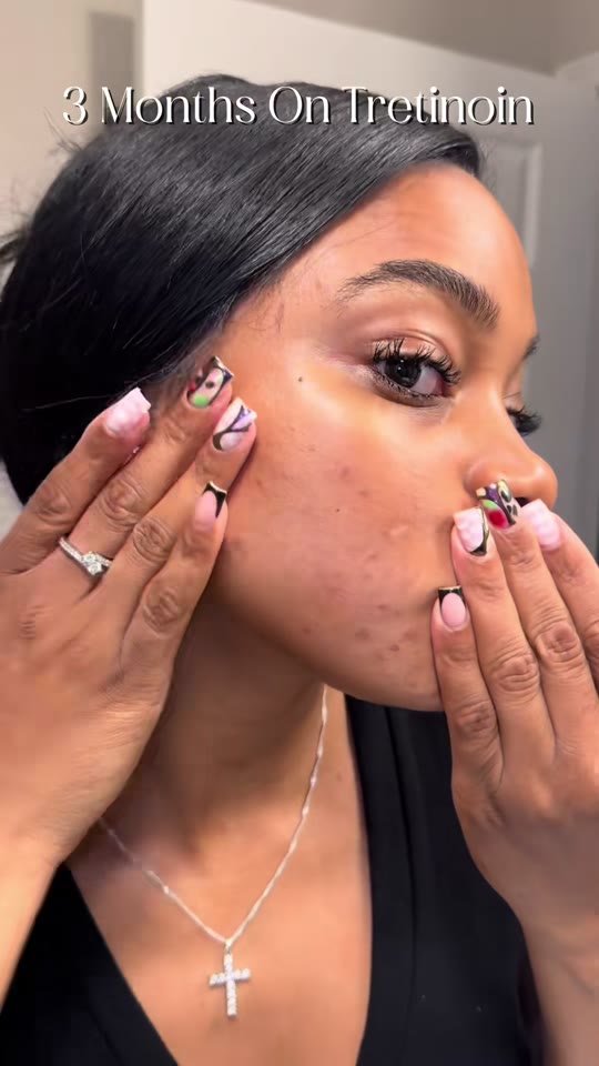 TRT and acne at month three: what the science says