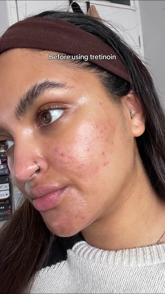 Tretinoin for acne: what five months of TikTok results actually mean