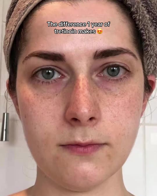 Tretinoin for anti-aging: separating real results from TikTok glow-ups