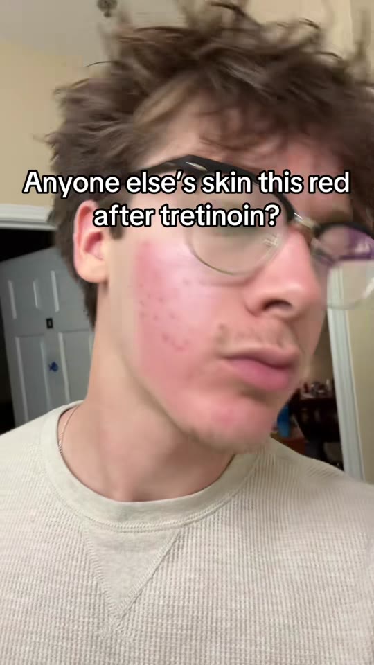 @nerblifts's tretinoin transformation claim, fact-checked