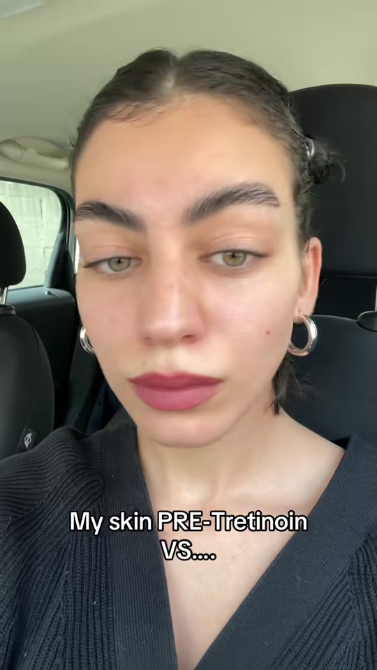 Tretinoin 0.05% for acne and texture: what a year actually does