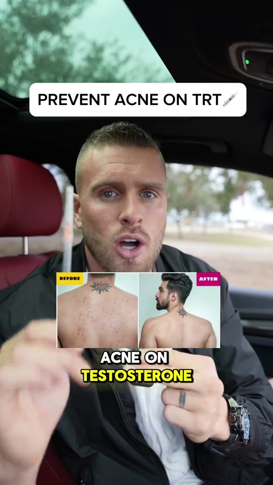 Can you actually prevent acne on TRT, or is it just damage control?