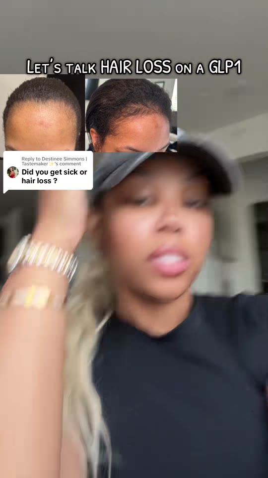 @bodiedbyb's hair loss and GLP-1 claims need context