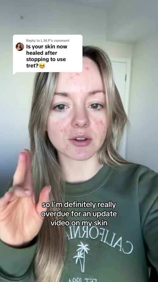 Tretinoin for acne and anti-aging: separating fact from TikTok hype