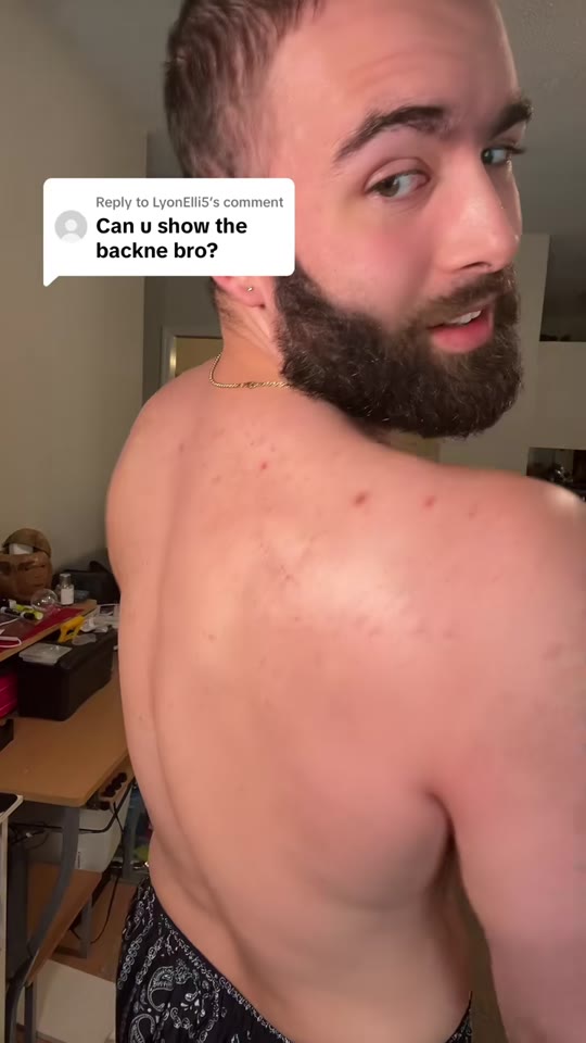 @popethecoach's TRT acne claims need more context