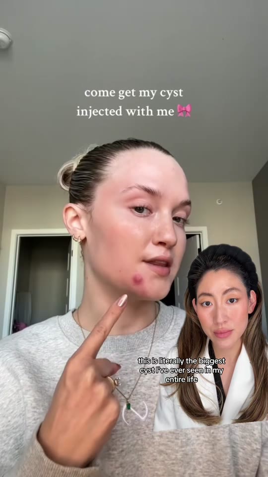 TikTok cystic acne advice from @dr.zionko, fact-checked