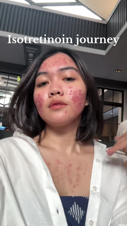 @cemdis's acne transformation claims need context