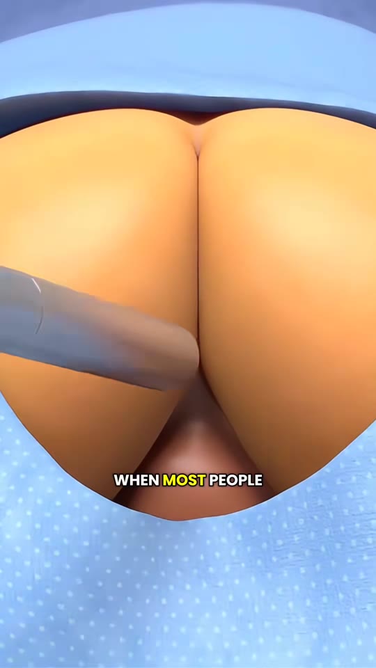 Transperineal prostate biopsy: what the animation probably gets right