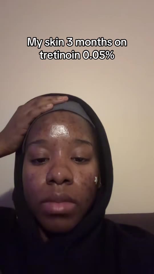 Tretinoin and TRT: separating the skin science from the hype