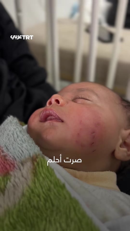 Rodent bites in Gaza displacement camps: what the health risks actually are