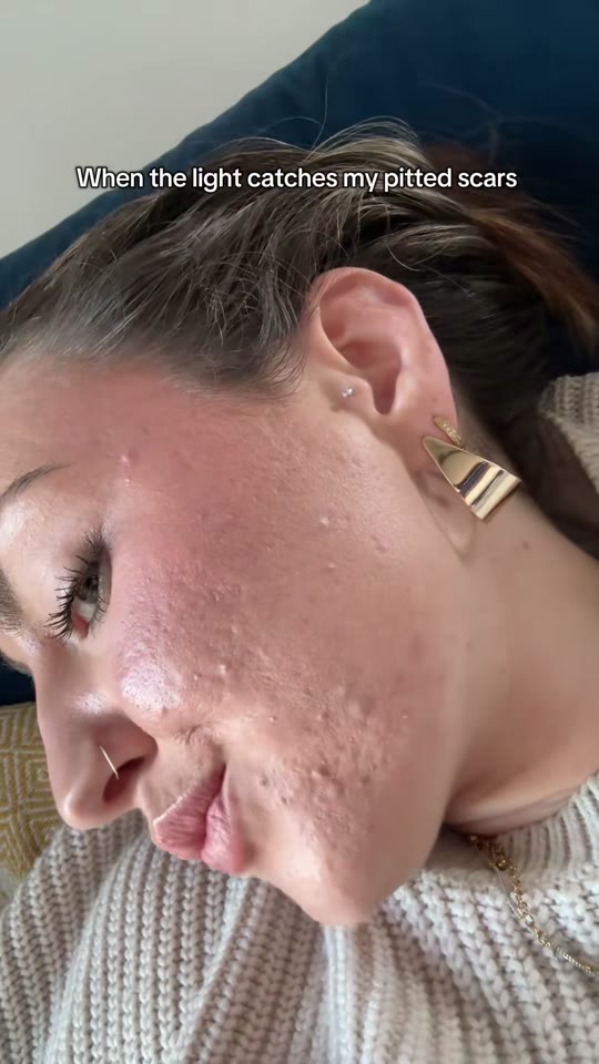 TikTok acne positivity post doesn't mention TRT connection