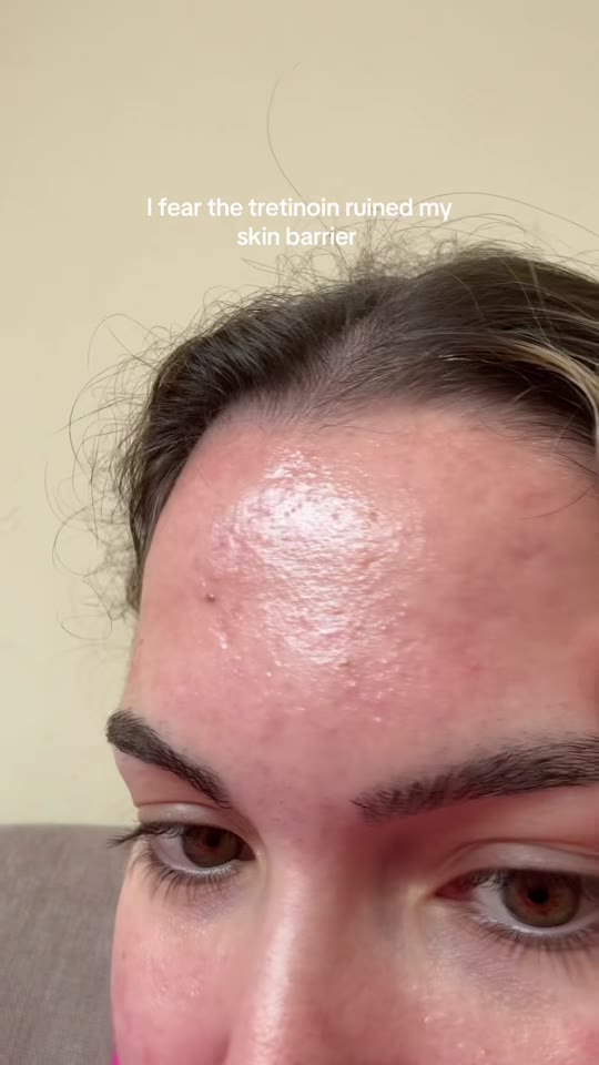 @jzozzy's tretinoin texture panic, fact-checked
